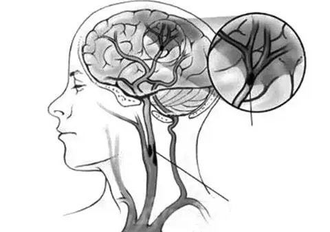 是由于大脑皮层