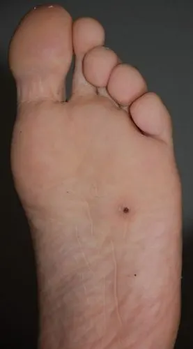 容易癌变的黑痣图片6