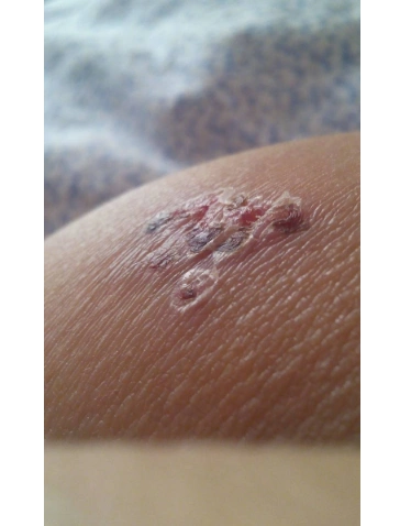 梅毒前期小红点图片 (13)