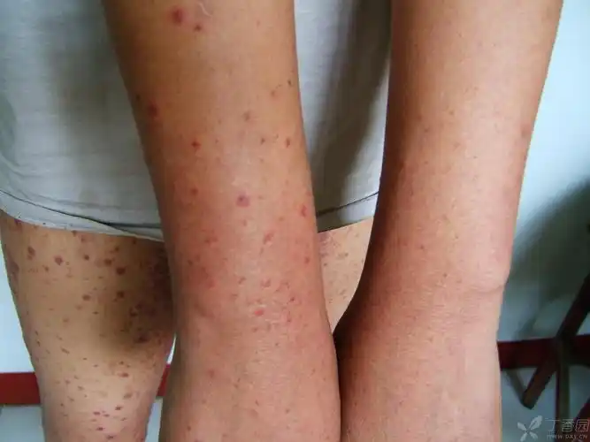 【请教】变应性血管炎还是过敏性紫癜