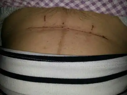 太多妈妈不知道生产时医生侧切好还是自然撕裂好