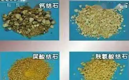 泌尿系结石有32种成分,最常见的成分为草酸钙,其他成分的结石如磷酸铵