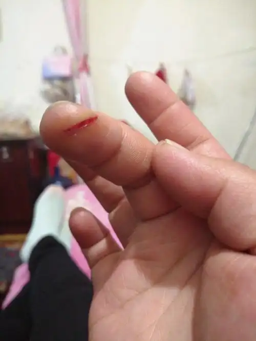 亲们怀孕22周了今天把手割伤了没事吧