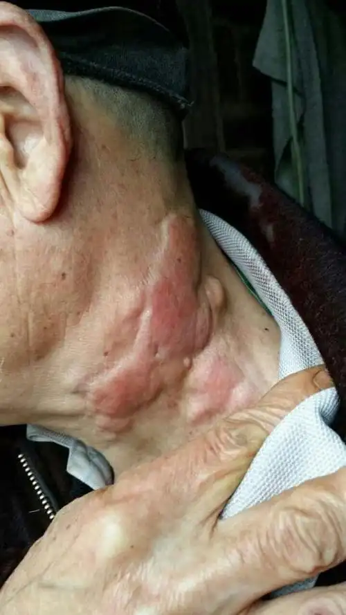 为什么脖子上淋巴会发炎