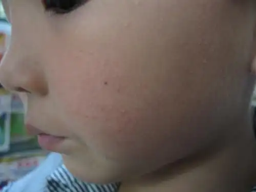 2013-12-11 卓美英 主任医师 儿子脸上毛周角化,耳朵旁边的脸颊上有