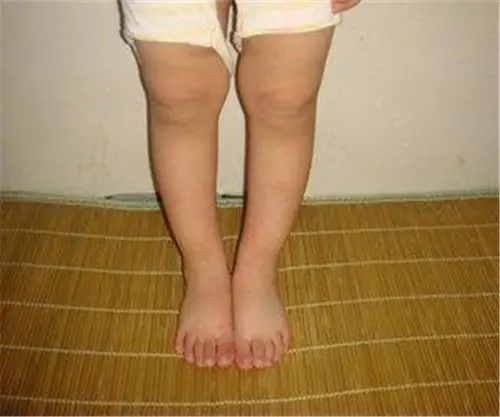 宝宝缺钙佝偻病的症状图片小儿佝偻病的症状小儿佝偻病的症状图片小儿