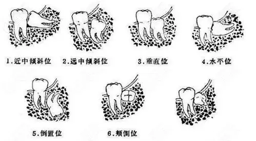智齿生长的位置