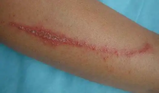 人体皮肤接触少量毒液后(如隐翅虫从皮肤上爬过),皮肤会出现点状,片状