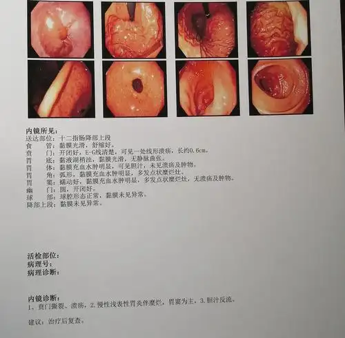 不要得胃病啊更新胃镜胆小者慎入