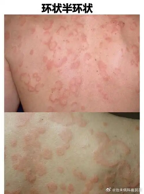 您的荨麻疹风团长啥样?属于什么类型?