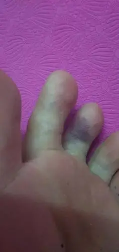 问答库脚丫踢到淤青了.怎么样更快好.