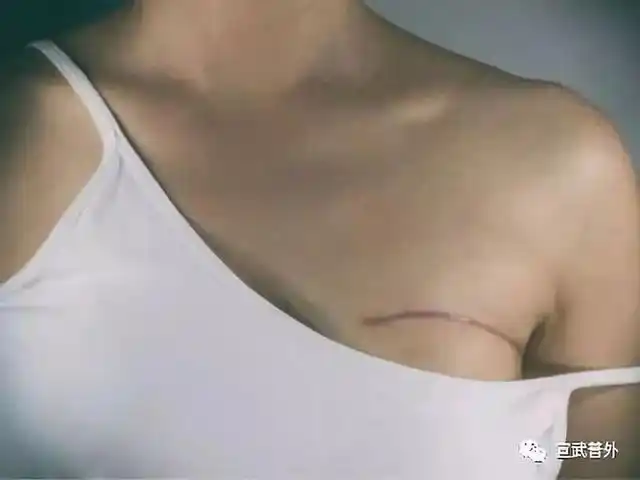 乳房全切手术后,形象不完整,怎么办?可以试试这个方法