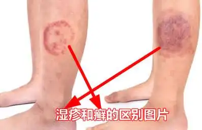 和小孢子菌是引起癣的2种最常见的真菌)是一种传染性的感染,湿疹不是