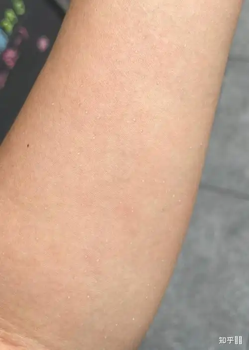 运动过后手臂有许多小水泡是什么原因