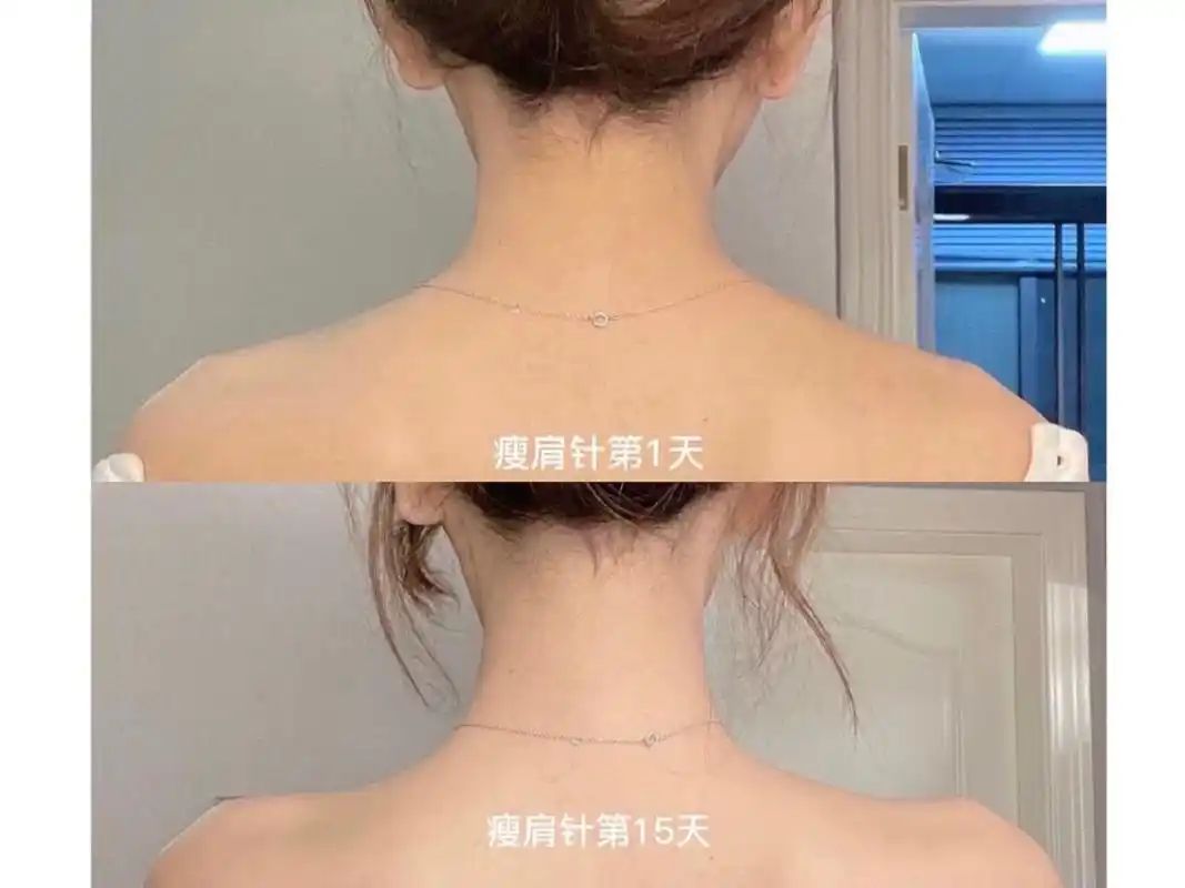 你离直角肩,也许只差一支瘦肩针?