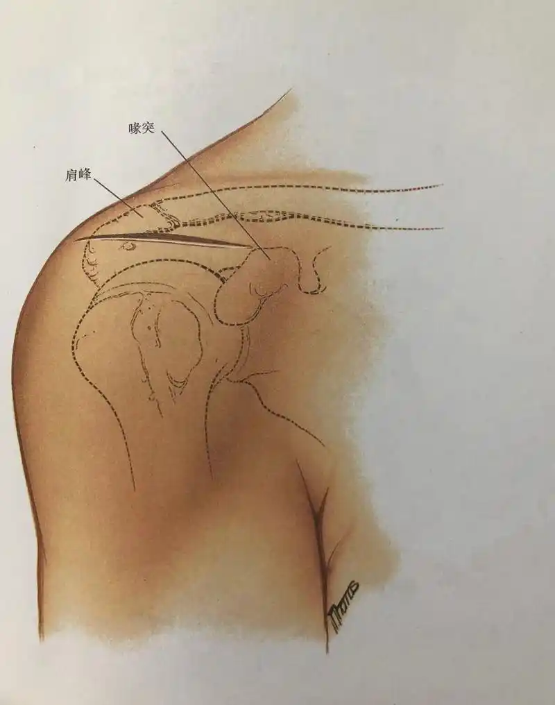 肩关节前外侧入路