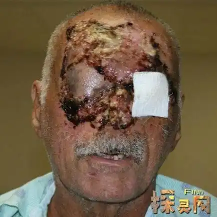 美国食脸男鲁迪尤金将裸体男子脸啃掉大半吸食浴盐毒品