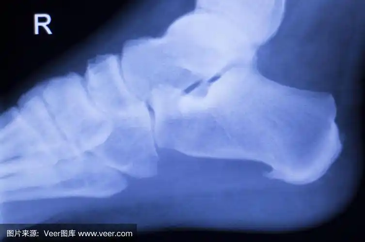 脚后跟踝关节损伤x线扫描