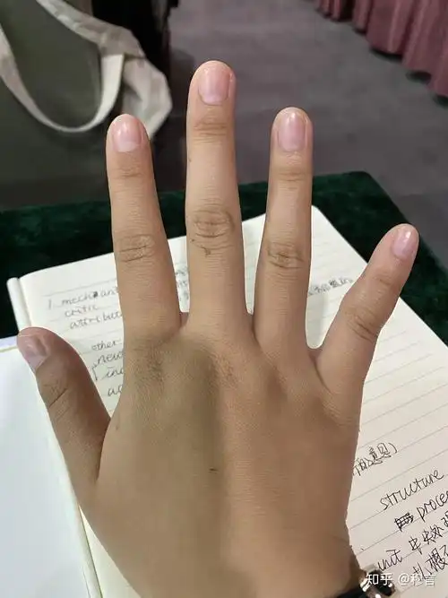 这是手指歪了嘛?能否矫正? - 知乎