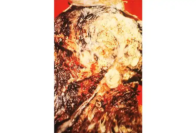 小细胞肺癌6问,你能答对多少?(上)