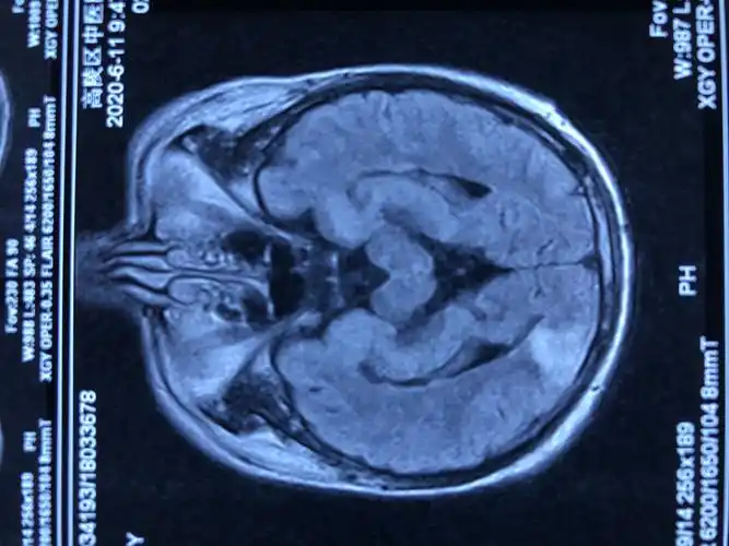 一例脑梗死患者的治疗体会