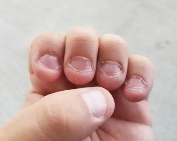 从小"咬指甲"的孩子,长大后如何了?医生:一般会有5种结局