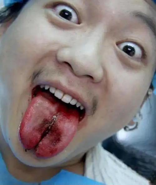 分舌手术的介绍