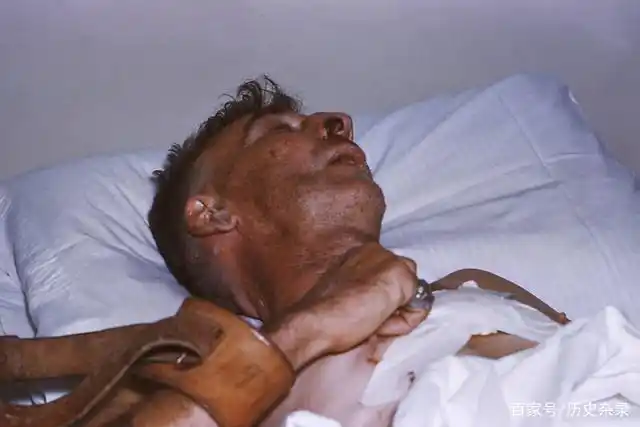 患者在被咬后几个月内可能都没有异常表现,但随着病毒蔓延开来,病人