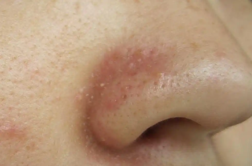 鼻翼两侧发红 附图片一张