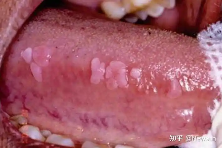 舌头尖锐湿疣症状 - 知乎