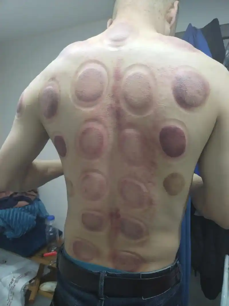 又扭到腰了.推推拿,拔拔罐,吃点儿六味地黄丸 - 抖音