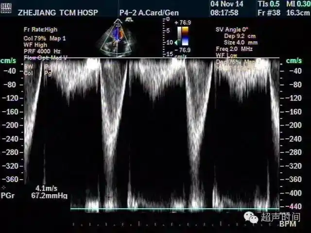 多图文解析主动脉瓣狭窄的超声诊断
