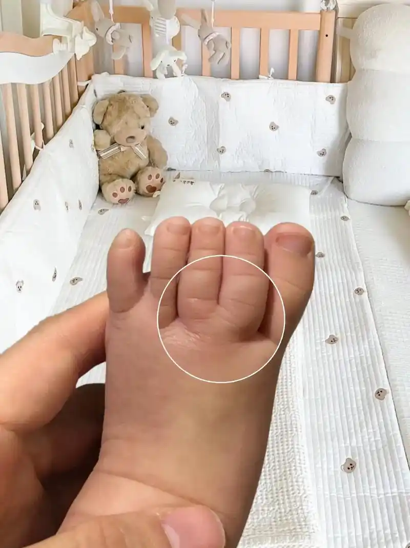 不懂就问,谁家宝宝的脚趾头也是这样的?