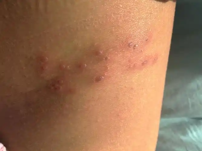 从海边旅游回来腰上起了好多小水泡是什么东西咬的还是起的?