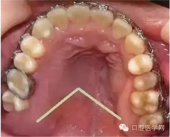 在临床上我们需要把牙槽骨增生和骨隆突区分开来,骨隆突是在颌骨上的