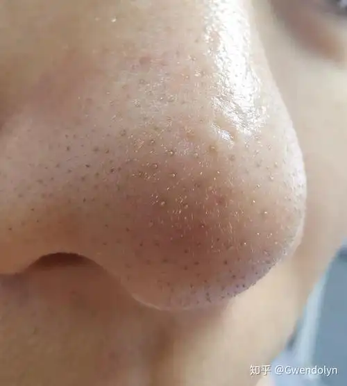 如何区别黑头和小棘毛雍症? - 知乎