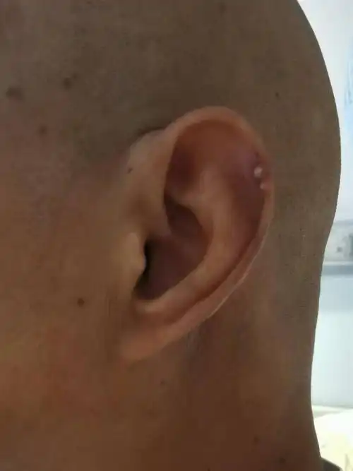 最近半年,韩先生左耳耳廓的位置也长出类似的疙瘩,有人认为是增生,有