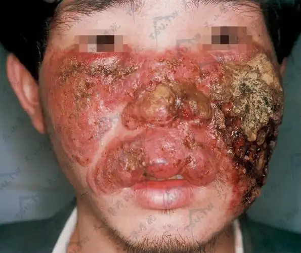 毛霉病病因症状诊断治疗参考