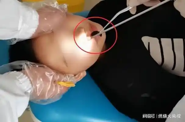 蚂蟥能在人体中生存多久男孩鼻腔中发现蚂蟥已被寄生半月