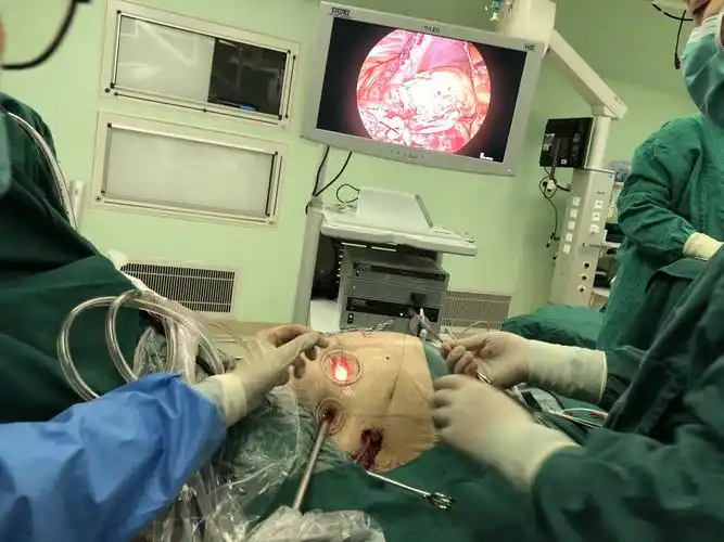 肥厚性梗阻型心肌病的全胸腔镜微创手术 - 好大夫在线