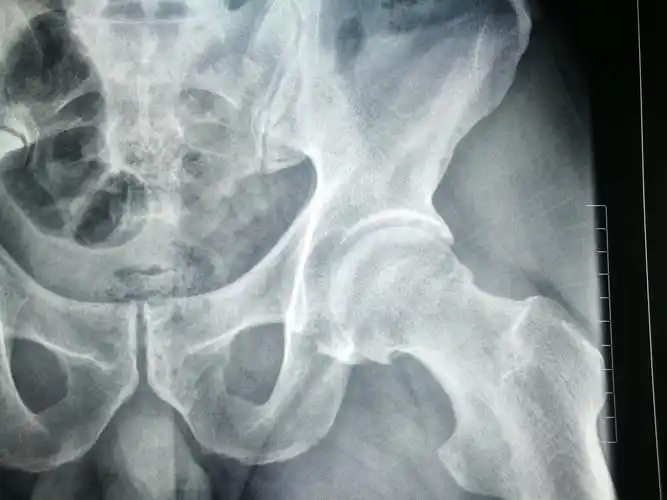 微创篇:我院成功开展髋关节镜下治疗髋关节撞击综合征一例