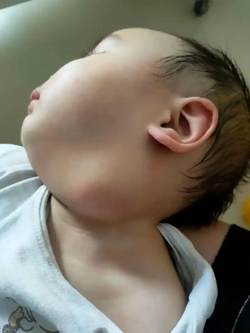 淋巴结肿大看了半个多月了,好难啊!炎症一直没消,又发烧又变大 - 抖音