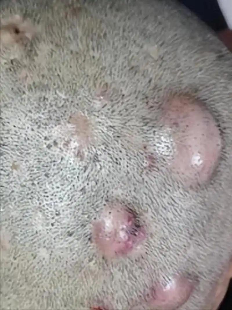 2,项部疤痕疙瘩性毛囊炎:在后发际线出现结节和硬块,青年男性易患且