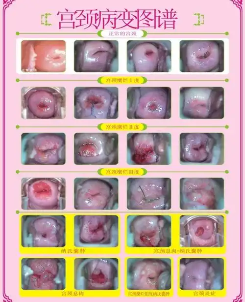 宫颈糜烂hpv阳性是宫颈癌吗,宫颈糜烂怎么治疗,宫颈糜烂用什么药好
