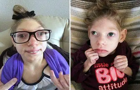 的调查人员正在调查寨卡病毒与出现在巴西的新生儿小头畸形之间的联系