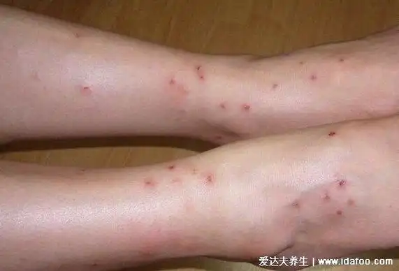 人被跳蚤咬的症状图片,虱子_大山谷图库