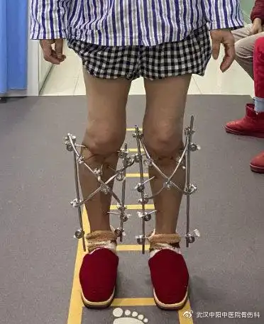 重度o型腿(膝内翻)可以矫正吗