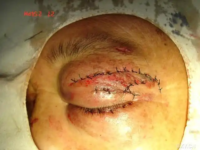 讨论〕秀一秀我们的眼睑急诊清创 [精华] [病例帖]