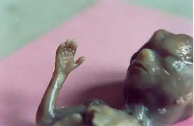 通常在这种胎儿先天有疾病的情况下,父母都会选择流产,但samuel armas