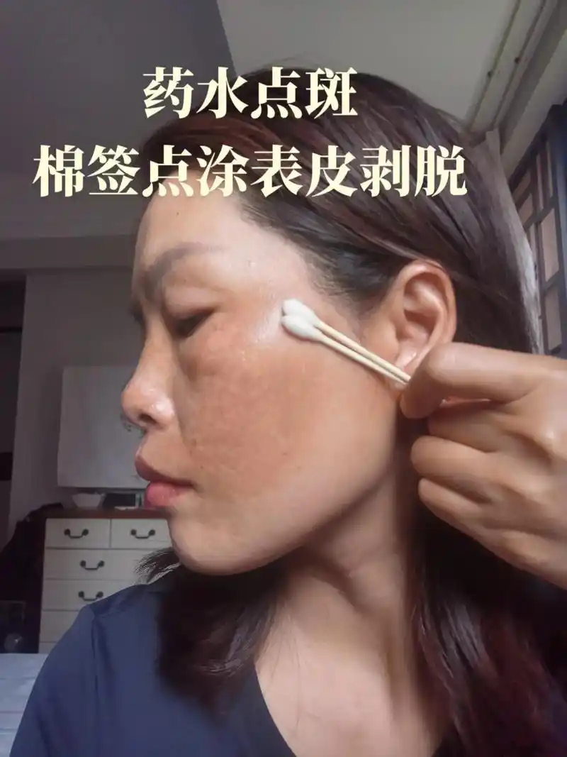 药水提取点斑,祛斑产品骗术之一.药水提取点斑,以前我也尝试过 - 抖音